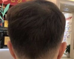 点击看大图 -大麦微针植发全国连锁