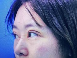 体验后-西安壹加壹医疗美容·西北抗衰旗舰店