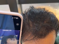 -碧莲盛·不剃发植发