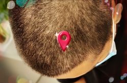 -大麦微针植发全国连锁