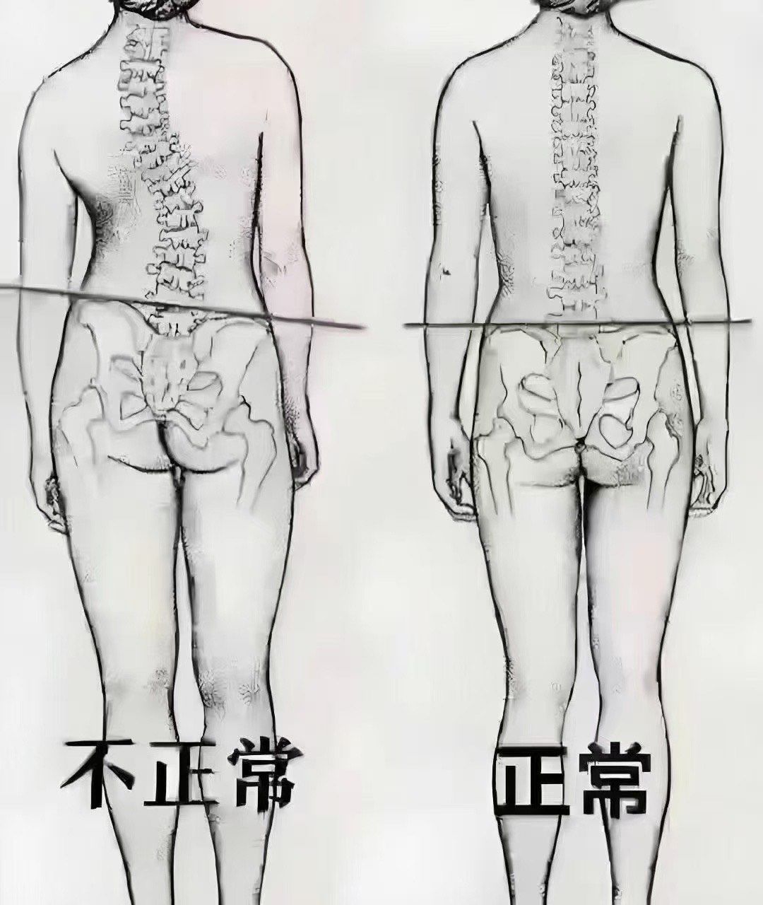 体态大揭秘!脊柱侧弯和正常体态对比,快自查