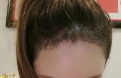 -大麦微针植发丨全国连锁