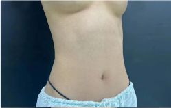 体验前-杭州米兰柏羽医疗美容医院