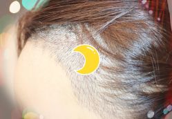 -大麦微针植发全国连锁