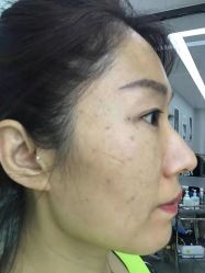 -悟空祛痘·诺奖技术专业店