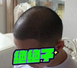 -大麦微针植发丨全国连锁