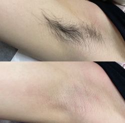 -薇兰专业脱毛连锁机构