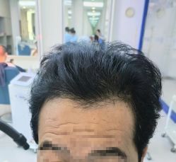 体验后-大麦微针植发全国连锁