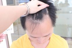 点击看大图 -大麦微针植发丨全国连锁