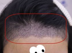 -大麦微针植发全国连锁