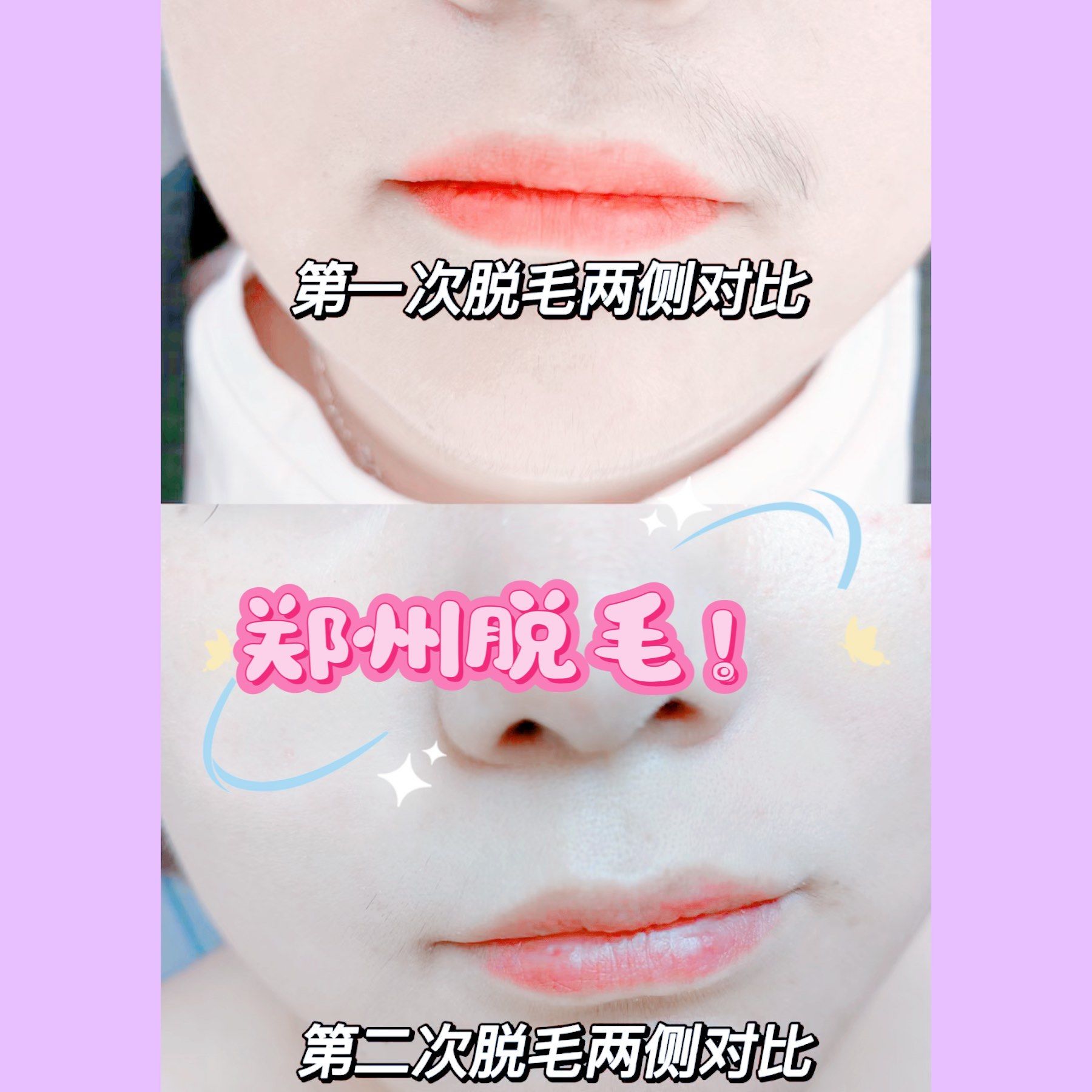 女士唇部脱毛效果对比90超干净[加油][加油][加油]