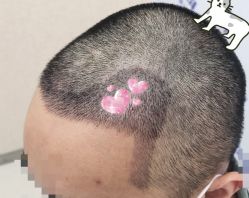 -大麦微针植发全国连锁