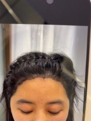 体验前-大麦微针植发全国连锁