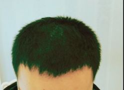 -大麦微针植发丨全国连锁