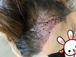 点击看大图 -大麦微针植发丨全国连锁