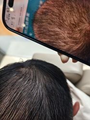 -碧莲盛·不剃发植发