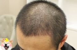 -大麦微针植发丨全国连锁