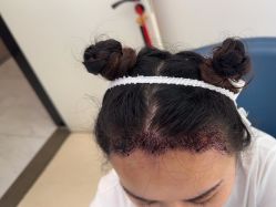 -大麦微针植发丨全国连锁