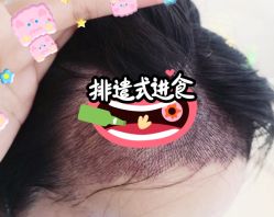 -大麦微针植发全国连锁