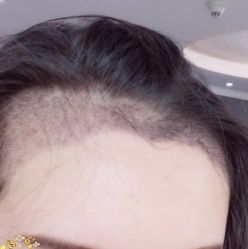 -大麦微针植发丨全国连锁