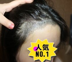 -大麦微针植发丨全国连锁