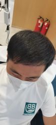 -大麦微针植发丨全国连锁
