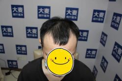 体验前-大麦微针植发丨全国连锁