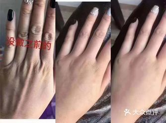 「罗曼罗兰美容美体中心(朝阳大悦城店)」针美汇手部抗