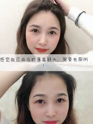 -大麦微针植发全国连锁