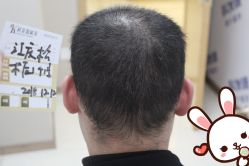 点击看大图 -大麦微针植发丨全国连锁