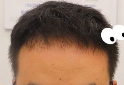 -大麦微针植发全国连锁