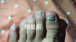 -德哥灰指甲脚气甲沟炎跖疣护理