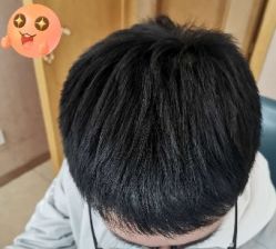 -大麦微针植发丨全国连锁