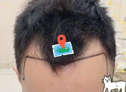 -大麦微针植发全国连锁