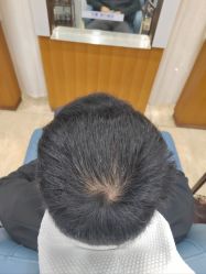 -大麦微针植发全国连锁