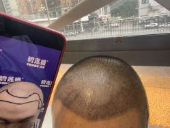 -碧莲盛·不剃发植发