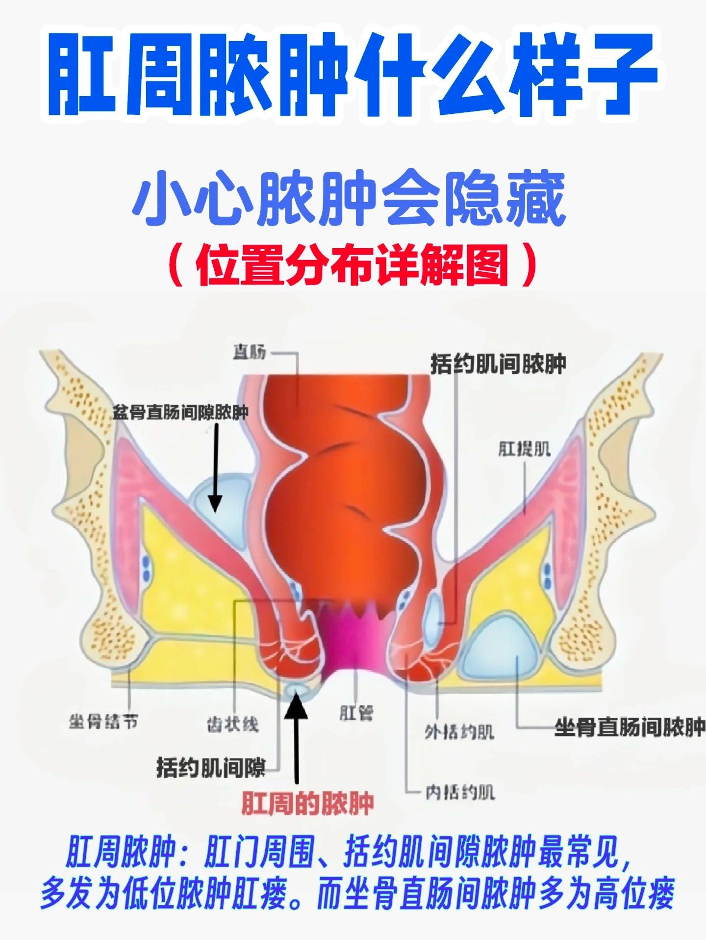 唐山肛肠医院:肛周脓肿的症状表现