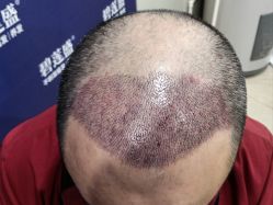 -碧莲盛·不剃发植发