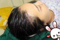 点击看大图 -大麦微针植发丨全国连锁