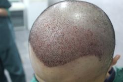 点击看大图 -大麦微针植发丨全国连锁