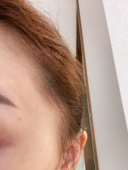 体验后-丽美妍医疗美容·皮秒·立体分层抗衰