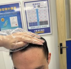 -大麦微针植发全国连锁