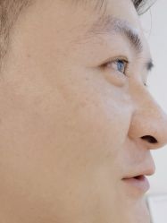 -塑青春&伊肤泉祛痘皮肤管理