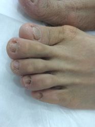 点击看大图 -德哥灰指甲脚气甲沟炎跖疣护理