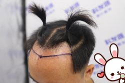 点击看大图 -大麦微针植发丨全国连锁