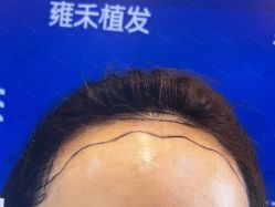 体验前-雍禾植发全国连锁