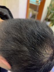 -碧莲盛·不剃发植发