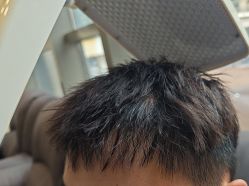 -碧莲盛·不剃发植发