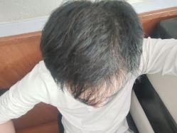 -碧莲盛·不剃发植发