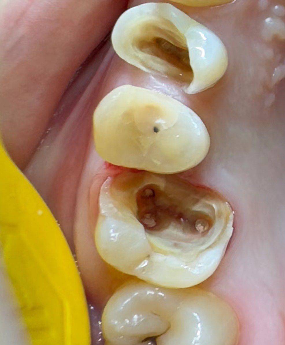 患者是小🍠网友,外院根管后没有做冠,吃东西牙齿崩了一块,还好牙根